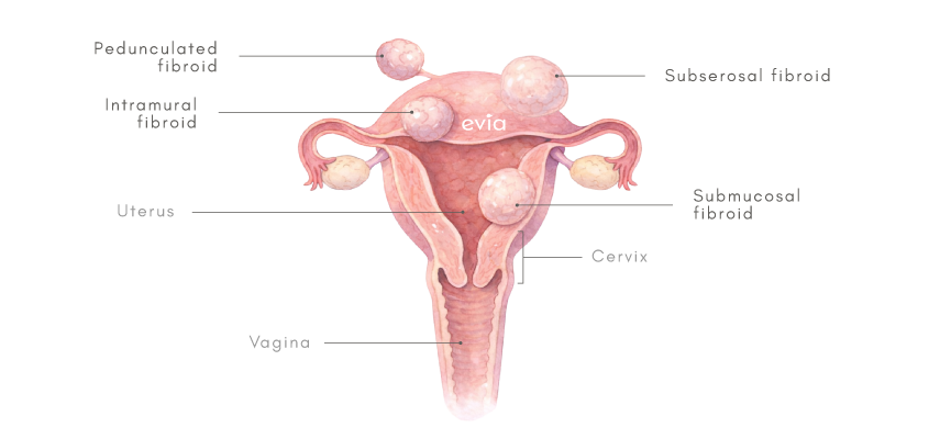 uterine fibroids