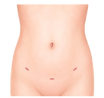 Laparoscopic myomectomy