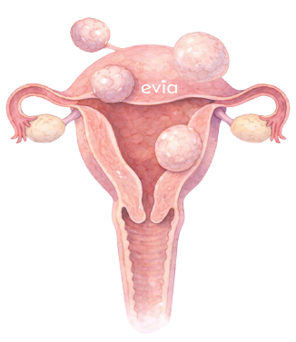 fibroids