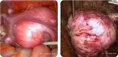 lap myomectomy