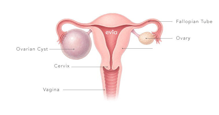 Evia_Website_Ovarian Cysts LP v5-01