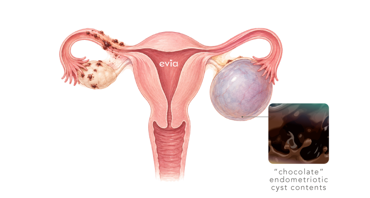 Evia_Website_Ovarian Cysts LP v5-02