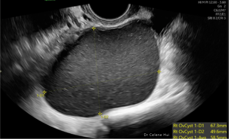 Evia_Website_Ovarian Cysts LP v5-03