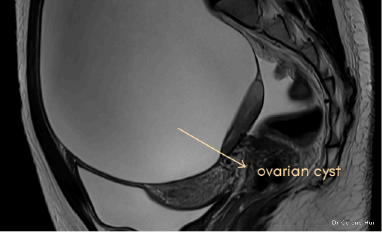 Evia_Website_Ovarian Cysts LP v5-04