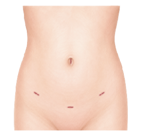 Evia_Website_Ovarian Cysts LP v5-08