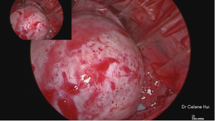 Evia_Website_Ovarian Cysts LP v5-09